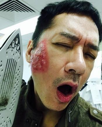 明星烫伤,意外瞬间，关爱与支持并行